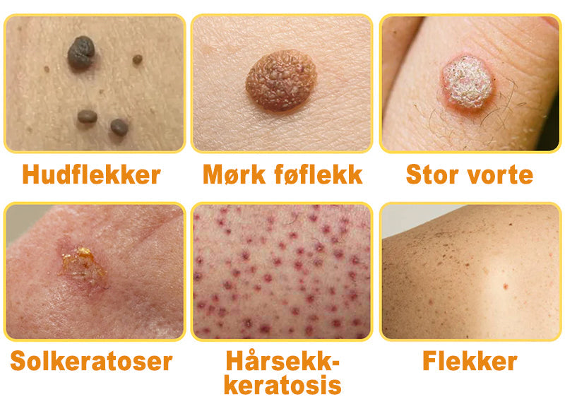 Raindew™ Bie Gift Behandlingskrem (🔥Siste dag, 80 % rabatt)