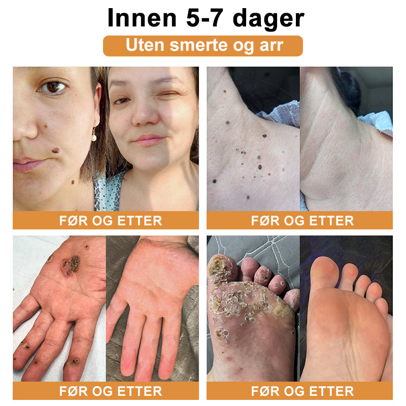 Raindew™ Bie Gift Behandlingskrem (🔥Siste dag, 80 % rabatt)